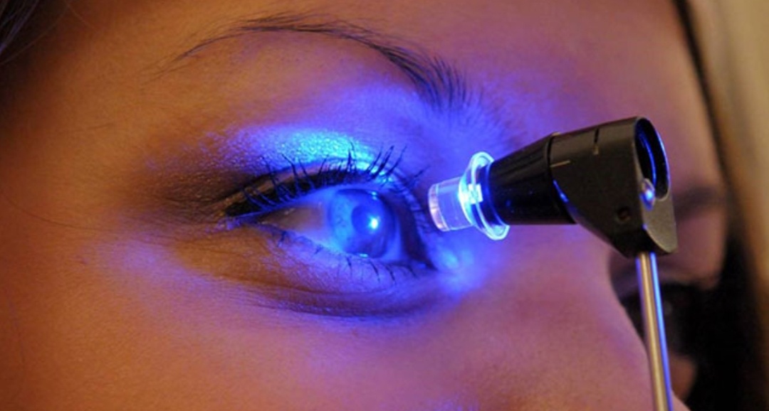 Кератоконус.