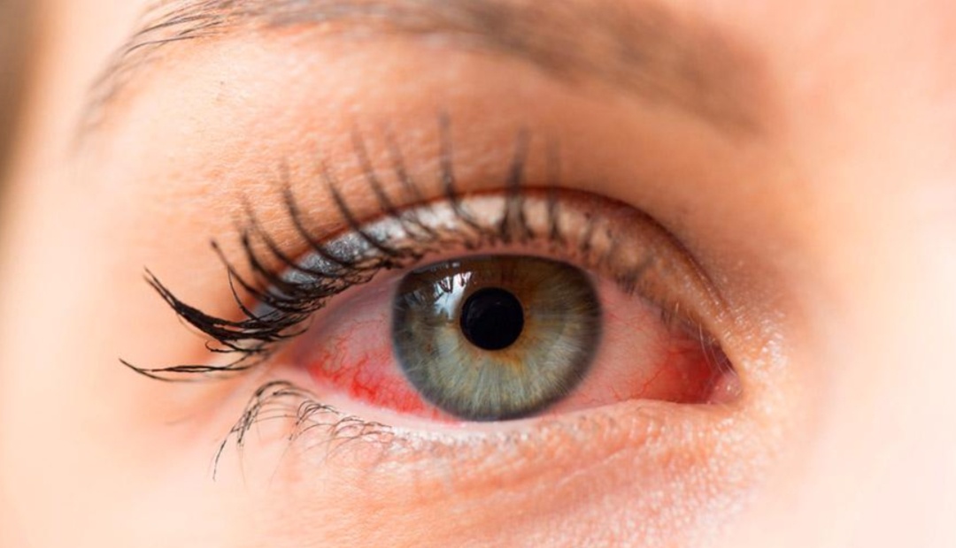 Синдром сухого глаза (ССГ).