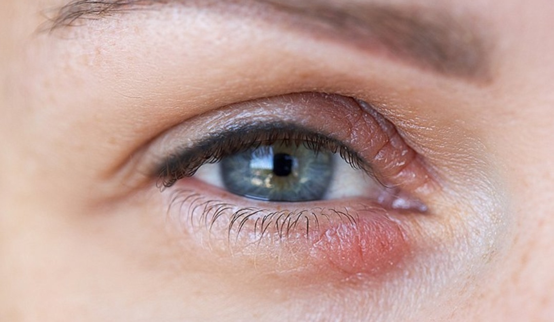 Блефарит — хроническое воспаление краев век.