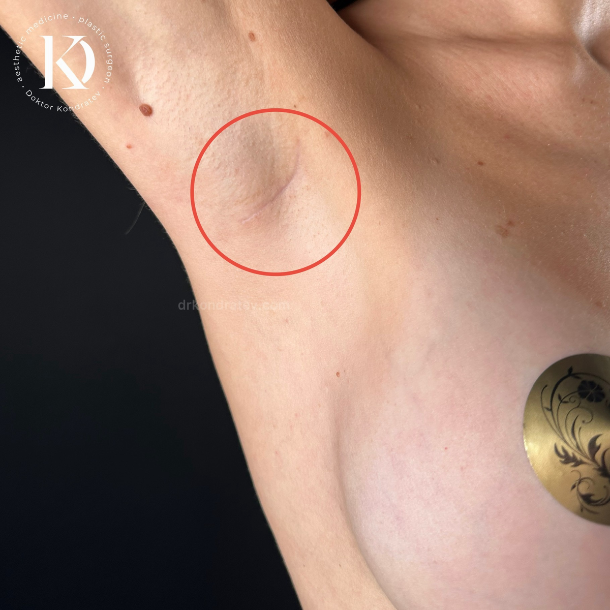 рубец от операции по увеличению груди через подмышку