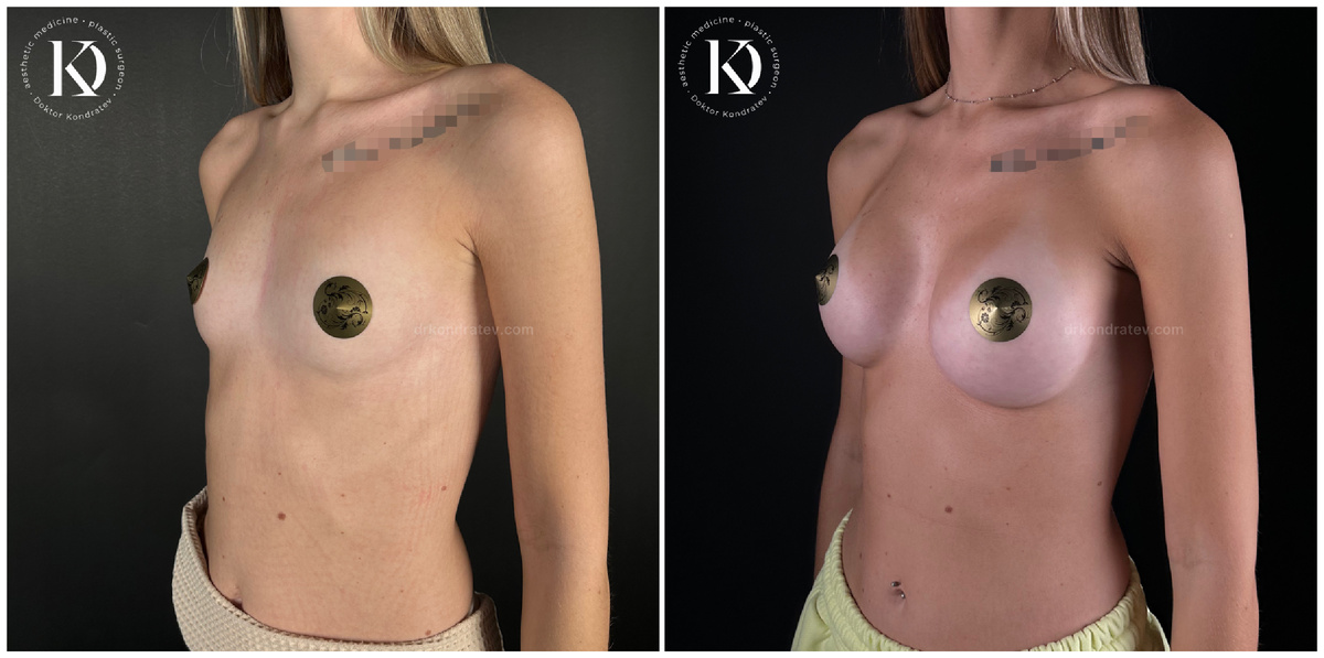 Увеличение груди через подмышку