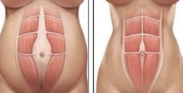 Можно ли делать упражнения на пресс при диастазе прямых мышц живота после родов?