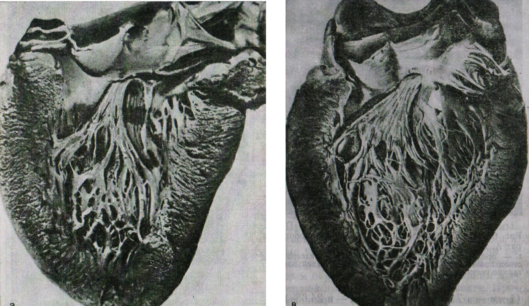 Разветвления левой ножки пучка Гиса