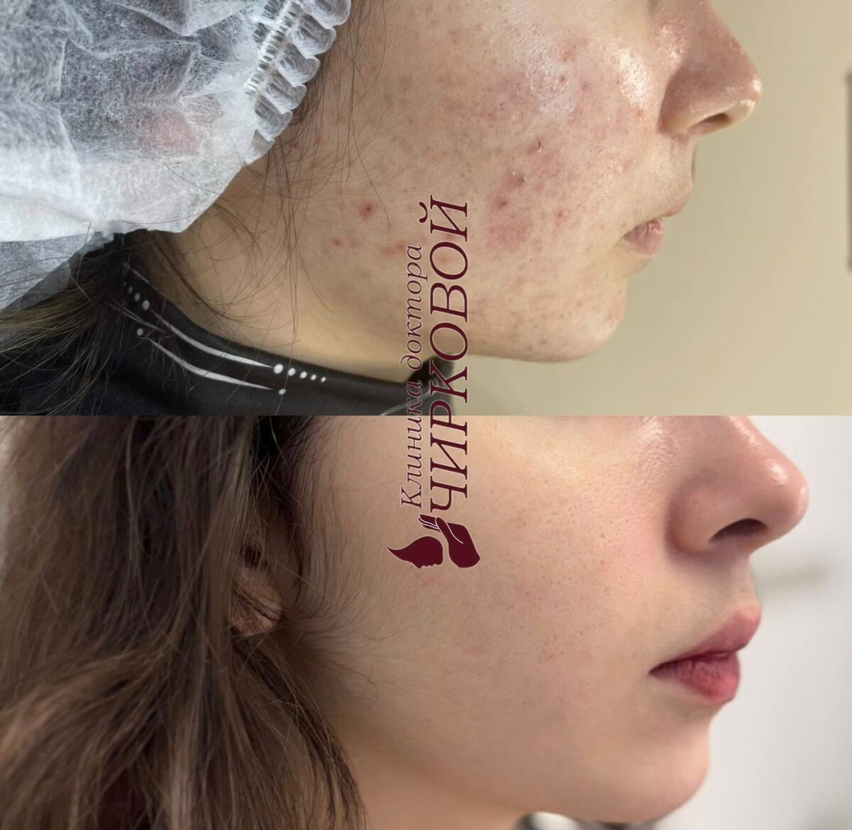 Лечение акне в клинике доктора Чирковой