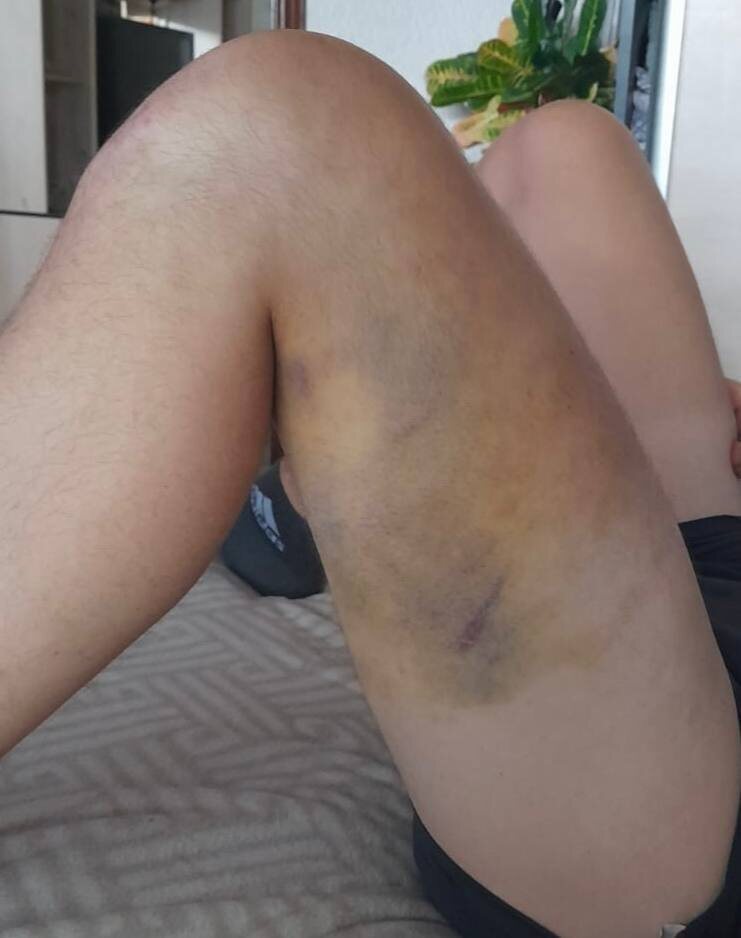 На фото: следы применения насилия со стороны полиции
