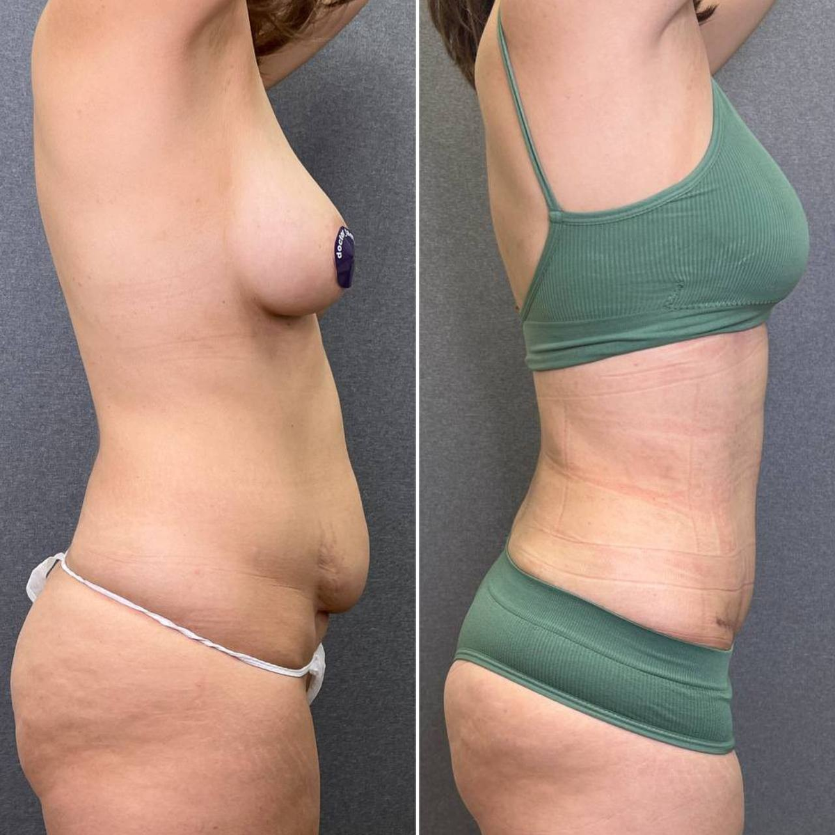 липоабдоминопластика