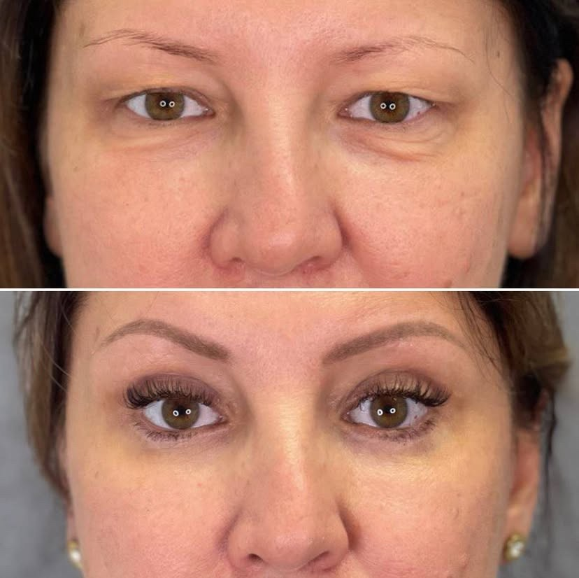 круговая блефаропластика 