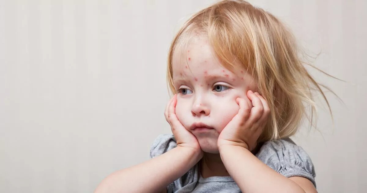 Обычно заболевание у детей протекает в легкой или среднетяжелой форме и лечится дома, под наблюдением педиатра.