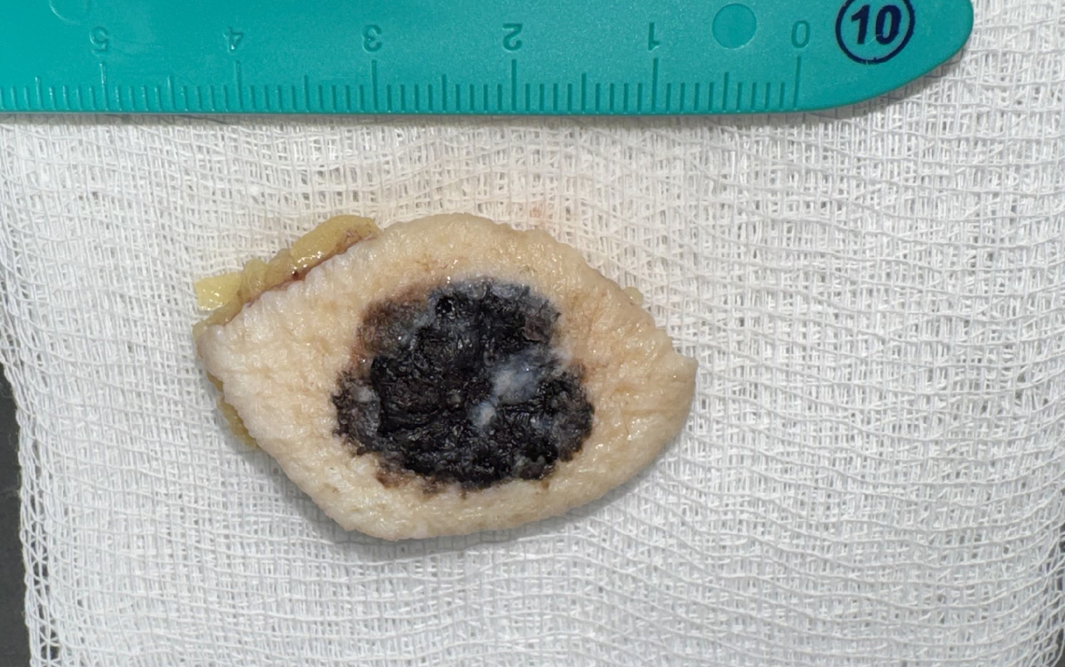 Удаленная пигментная меланома