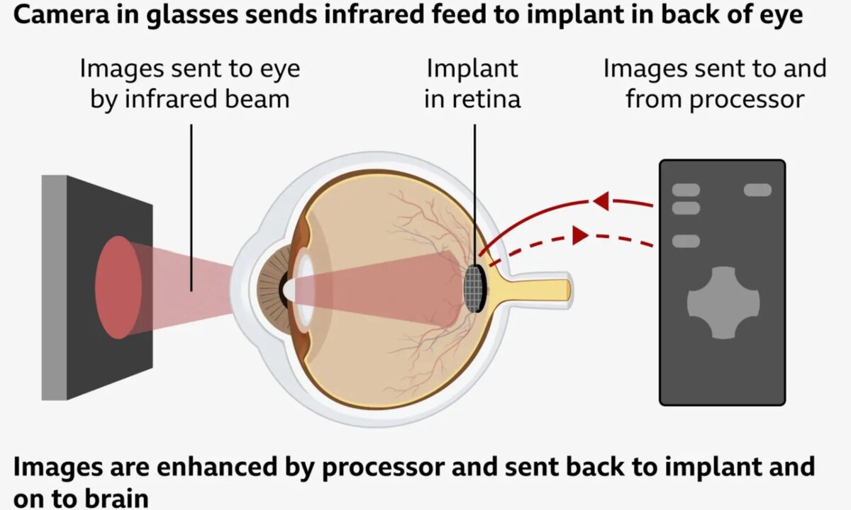    Ophthalmology Science/BBC