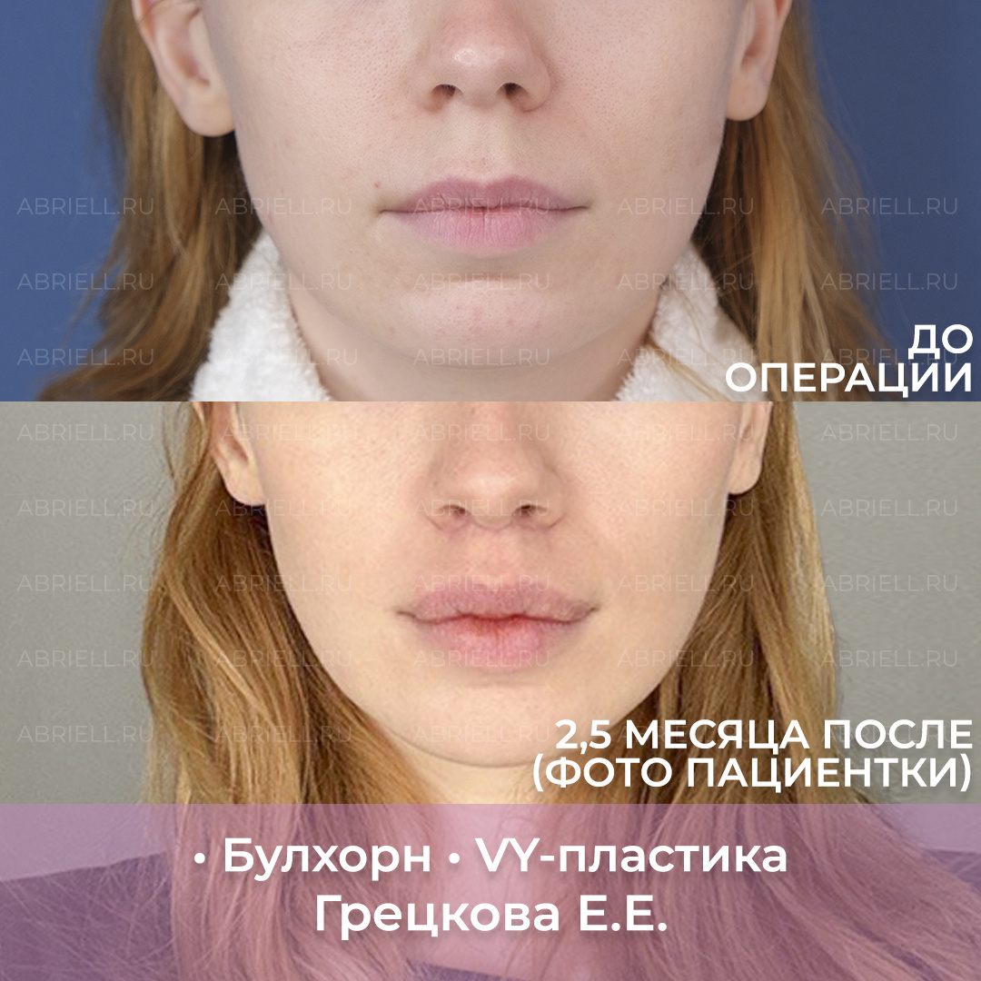 Булхорн и VY-пластика Увеличение губ в Санкт-Петербурге 