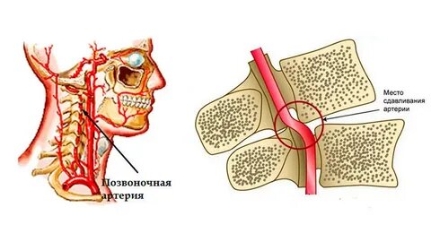 Головокружение из-за шеи: Как отличить от других причин и что срочно делать при «приступе».