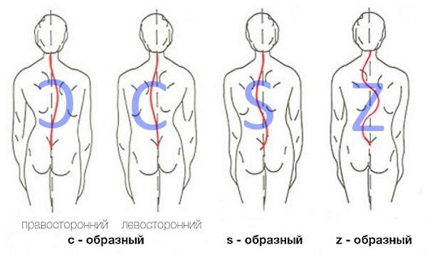 Такая сложная многоосевая деформация приводит к изменению формы ребер и грудной клетки (реберный горб), нарушению взаиморасположения органов грудной клетки, а также к функциональным нарушениям сердечно-сосудистой, дыхательной и нервной систем растущего организма.

