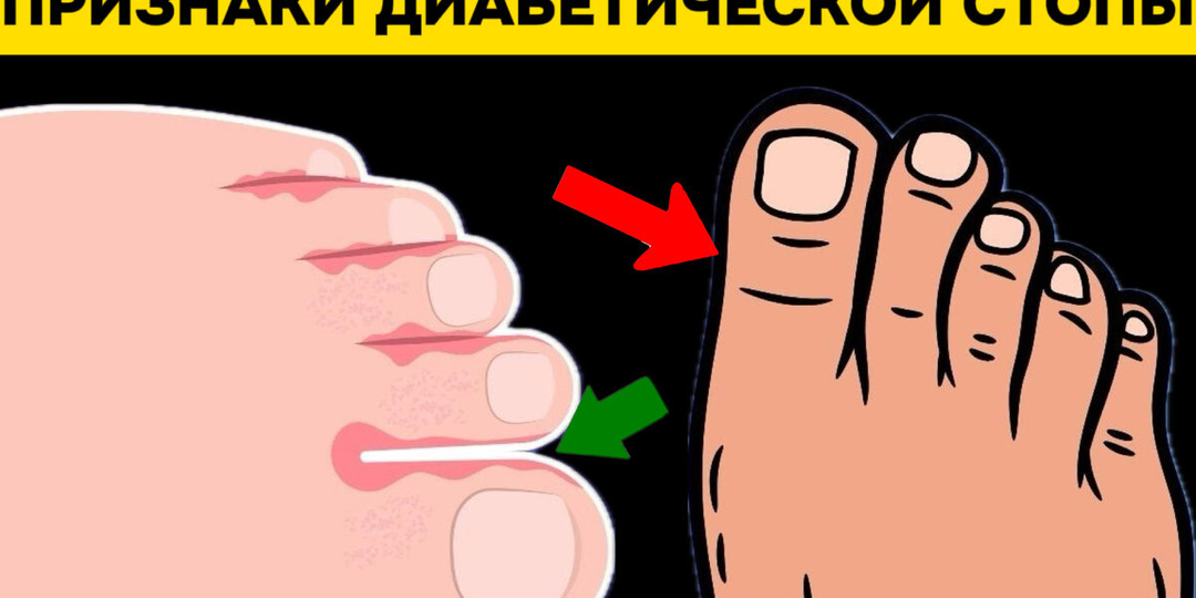 Диабет и стопы: 10 сигналов организма по версии эндокринологов