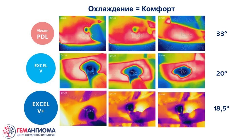 Сравнение охлаждения у аппаратов Vbeam Candela и Cutera Excel V. Чем холодней, тем лучше для пациента.