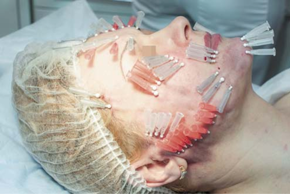 Пример бессмысленной и небезопасной НМ. Нет единой конструкции, нити вводятся в разные зоны без изъятия коннектора.