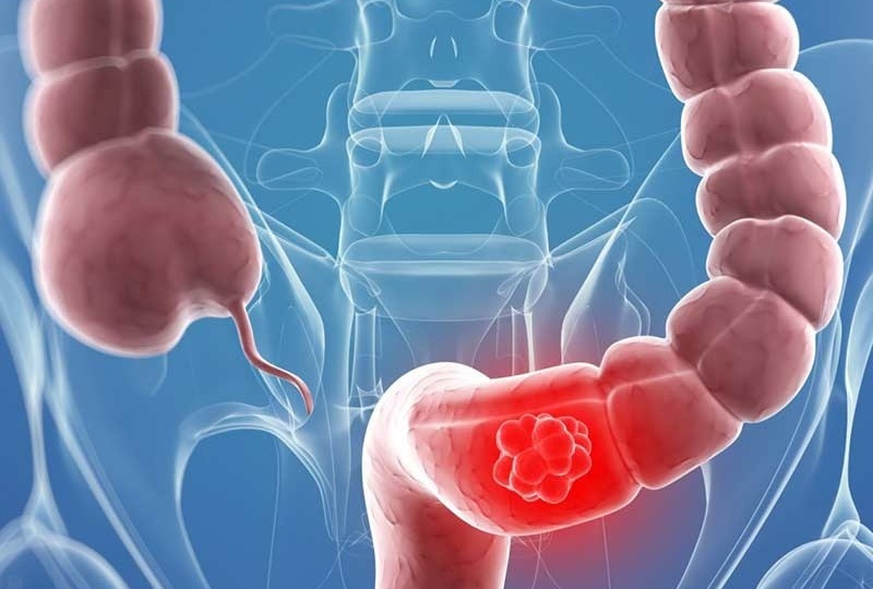 Воспаление толстой кишки: почему возникает и как вернуть здоровье кишечнику