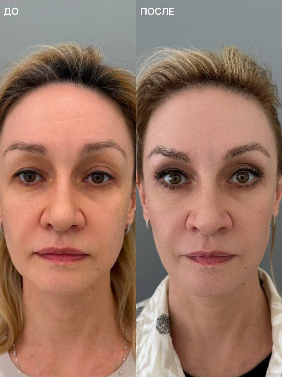 Open Eyes: открытый взгляд, до/после