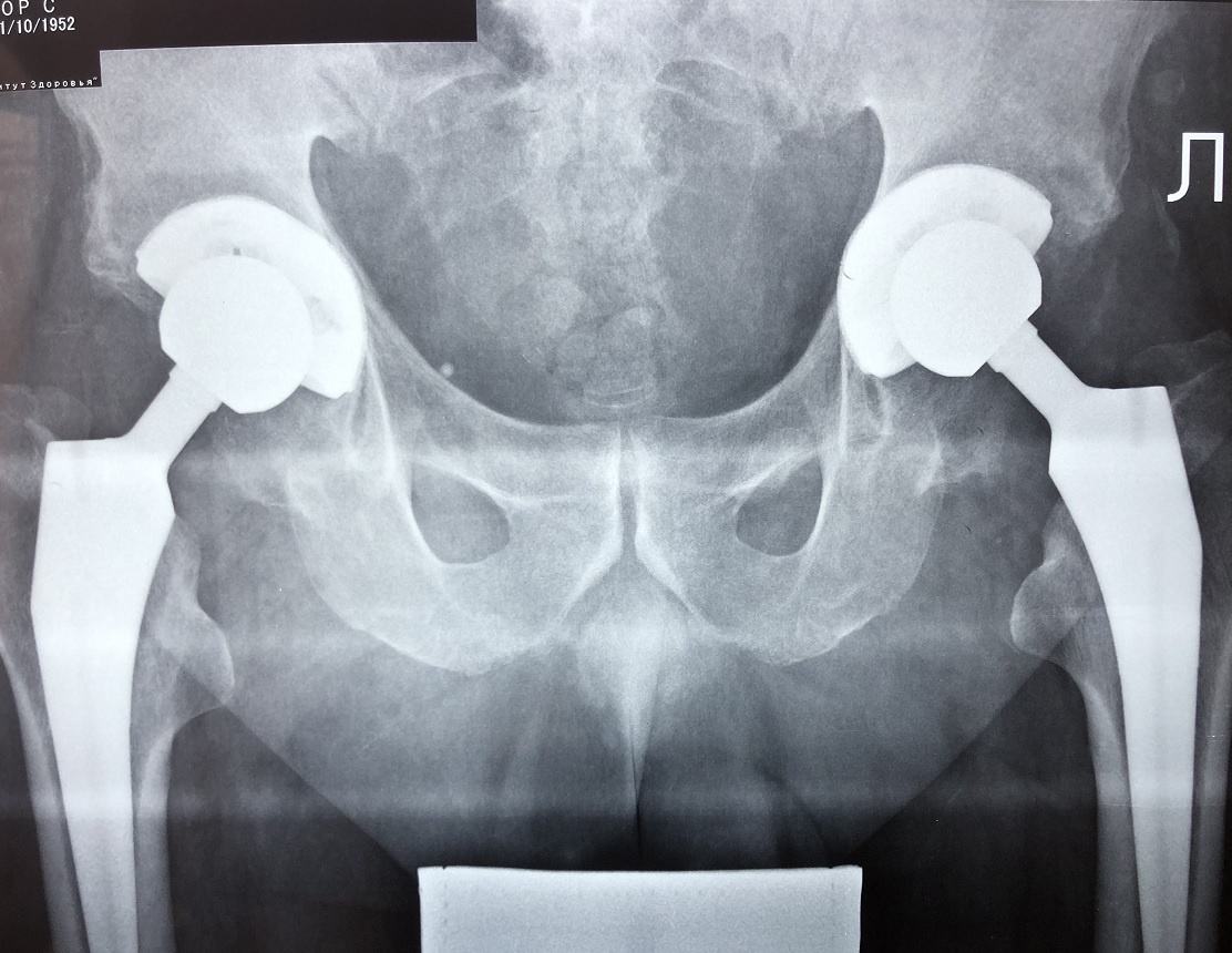 Двухсторонее протезирование тазобедренных суставов 