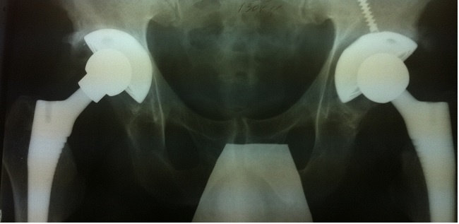 КАК ЖИТЬ ПОСЛЕ ОПЕРАЦИИ ПО ПРОТЕЗИРОВАНИЮ ТАЗОБЕДРЕННОГО СУСТАВА Часть 2 Первые дни после протезирования тазобедренного сустава