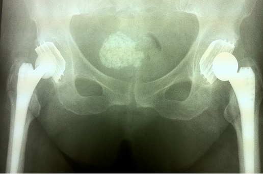 Двухстороннее протезирование тазобедренных суставов. Есть и еще одна патология....