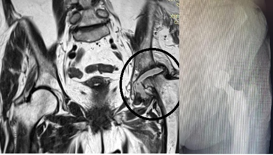 Асептический некроз головки тазобедренного сустава с полным некротизированием. Головка сустава отсуствует.