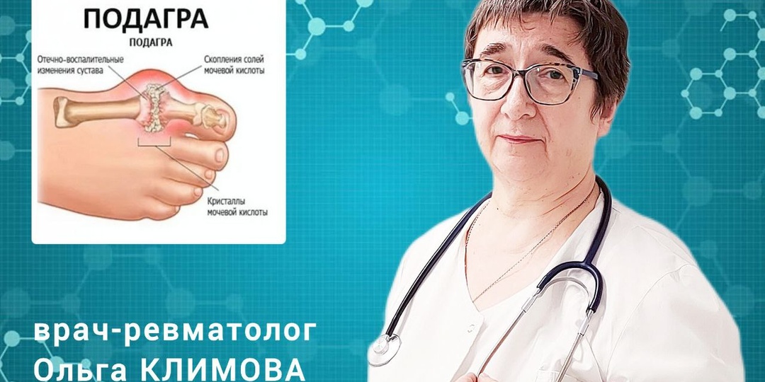 Как при подагре уйти от приступов. Мнение ревматолога Ольги КЛИМОВОЙ