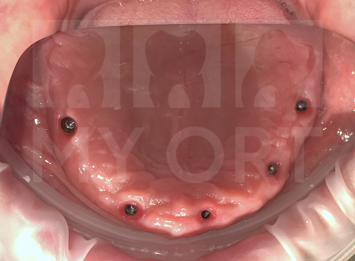 Установка 5 дентальных имплантатов на верхней челюсти - >