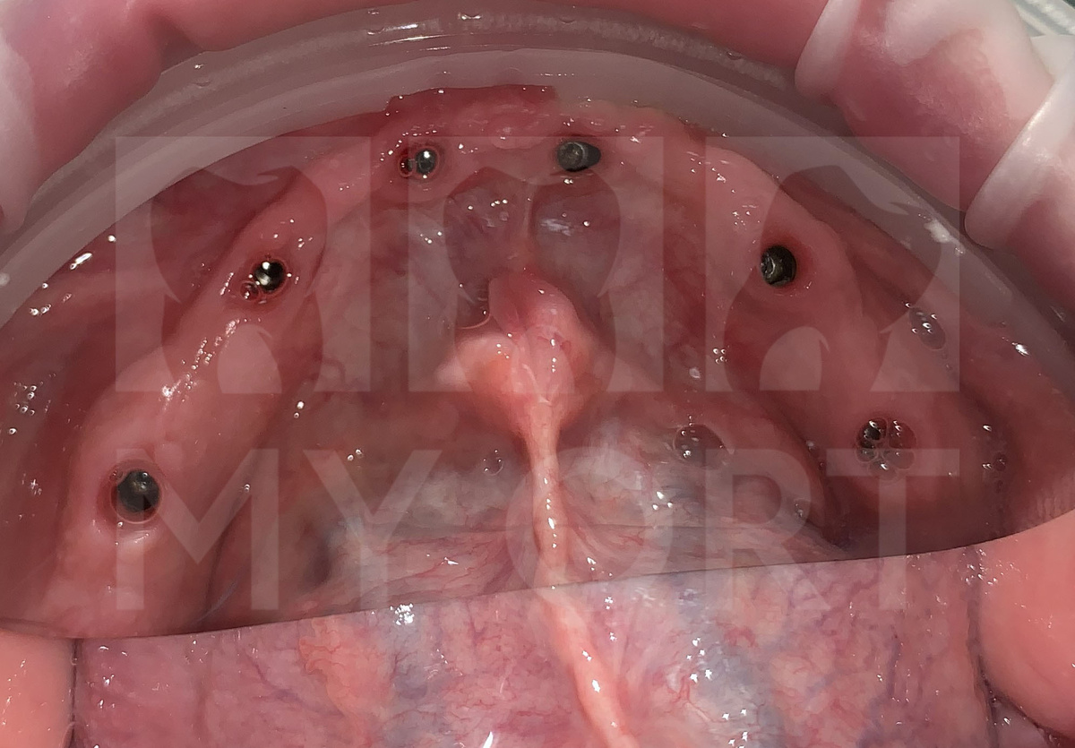Установка 6-ти дентальных имплантатов на нижней челюсти