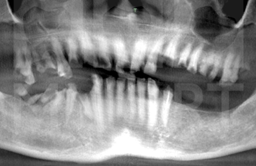 Неравномерная костная ткань в области верхнечелюстных пазух