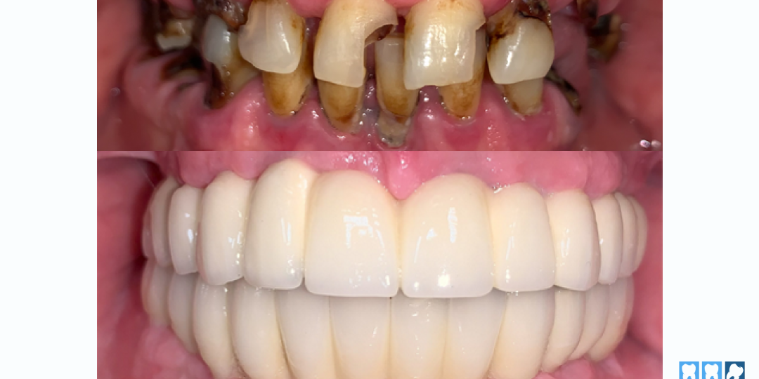 Комплексное восстановление обеих челюстей на 11 имплантатах: сложный клинический случай