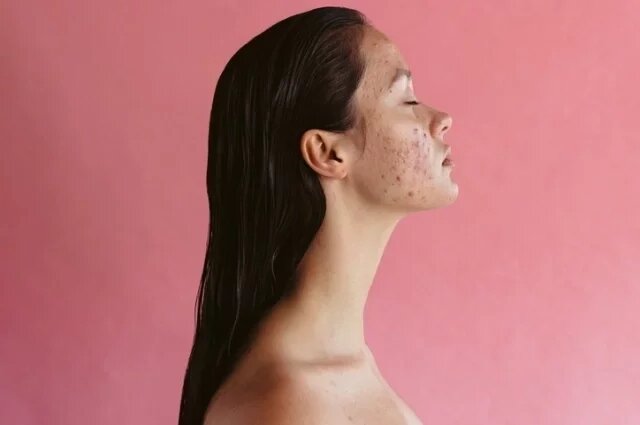    К чему снятся прыщи?