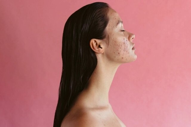    Сны о прыщах и высыпаниях обычно приходят к молодым дамам, чей организм только формируется и меняется в лучшую сторону. Фото: istockphoto.com
