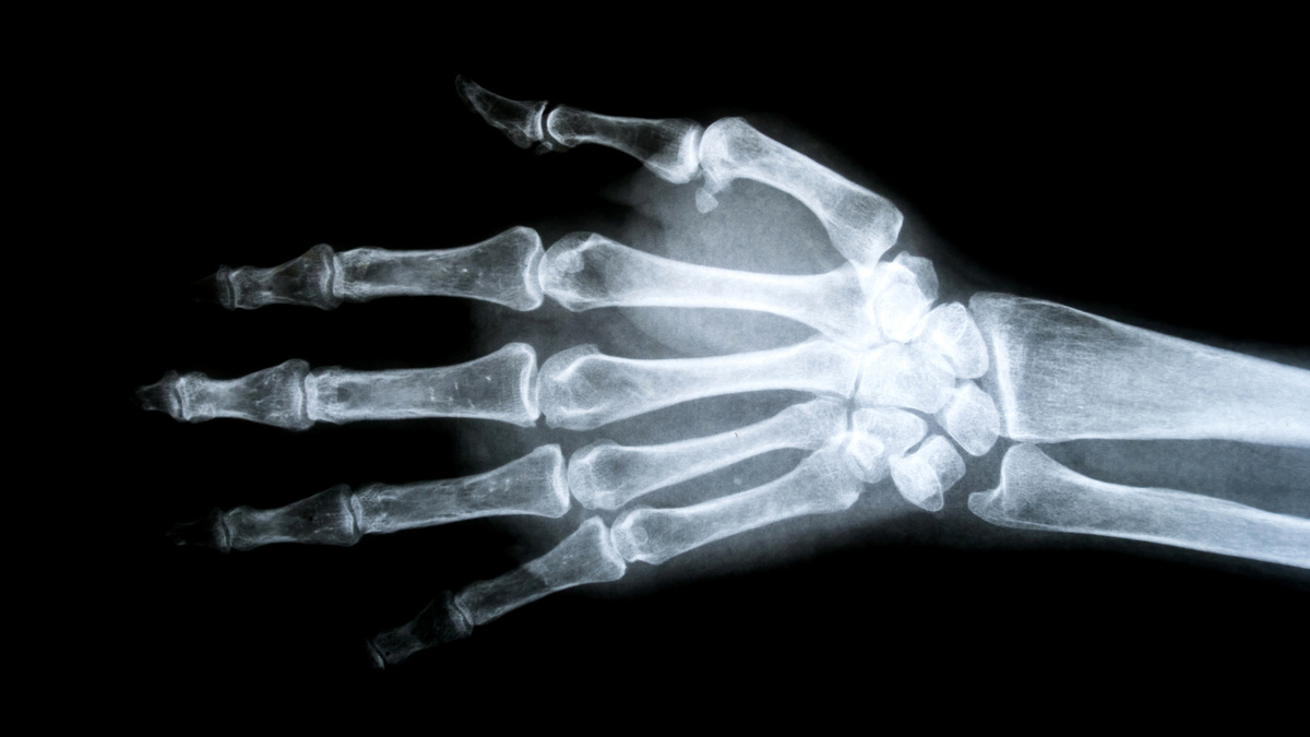     Фото: Thammanoon Khamchalee/Shutterstock/FOTODOM У людей с редкой мутацией в гене LRP5 кости во много раз плотнее нормы