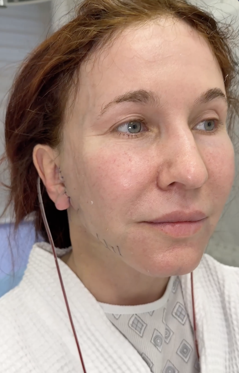 SMAS-подтяжка нижней трети лица с  платизмопластикой и липосакцией субментальной зоны. Пациентка на вторые сутки!