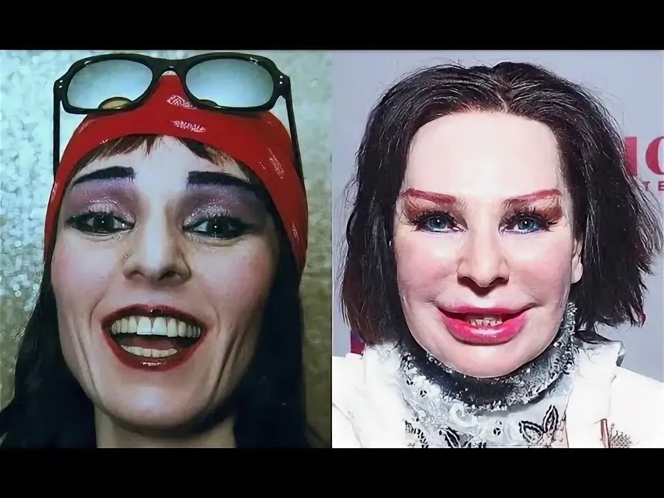 Жанна Агузарова в молодости и после пластической операции