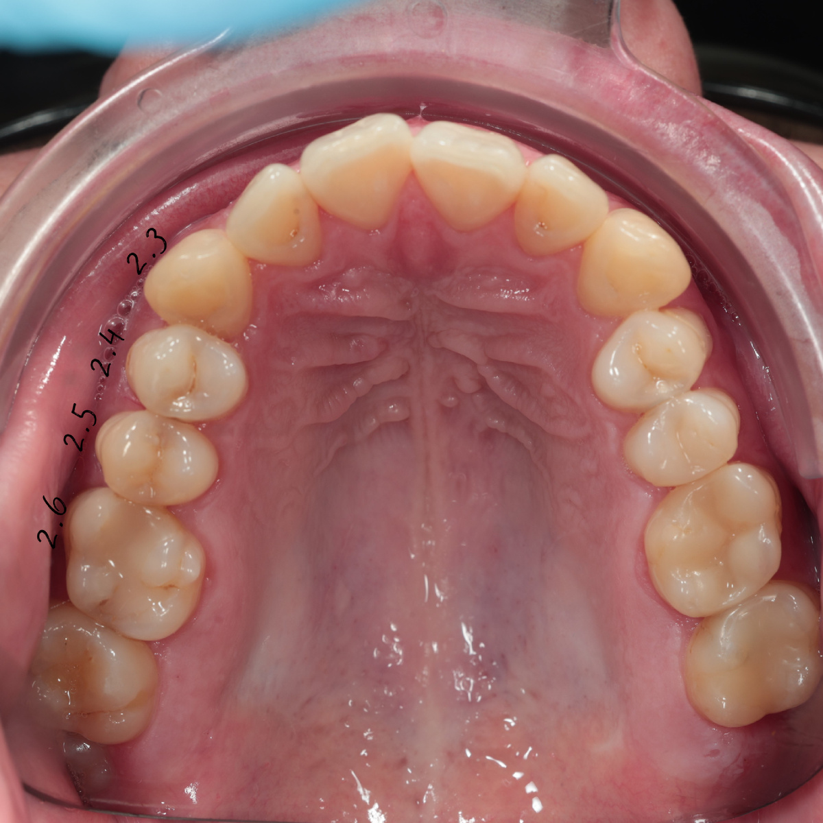 Так и не угадаешь, где поселился кариес ?!