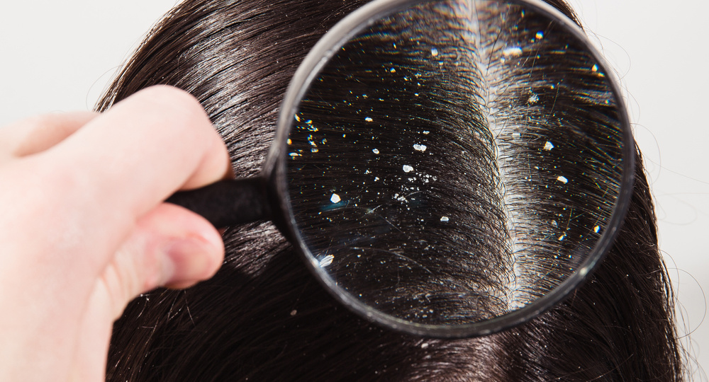 Себорея кожи головы: причины и лечение