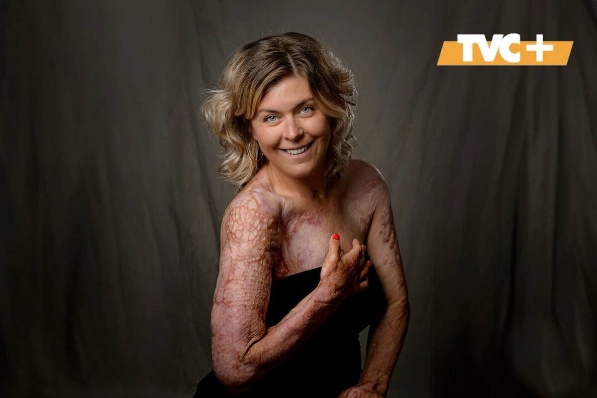 Эмма Шольс после пожара.