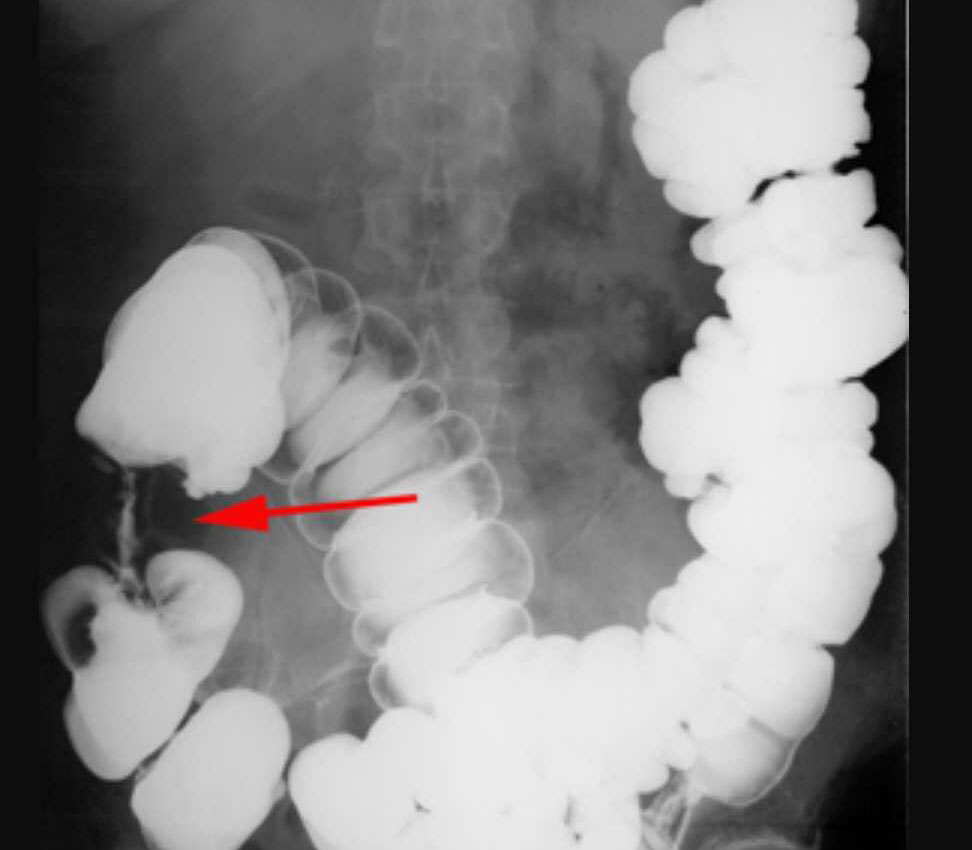 Ирригоскопия кишечника. Сужение просвета кишки в месте нахождения опухоли.
