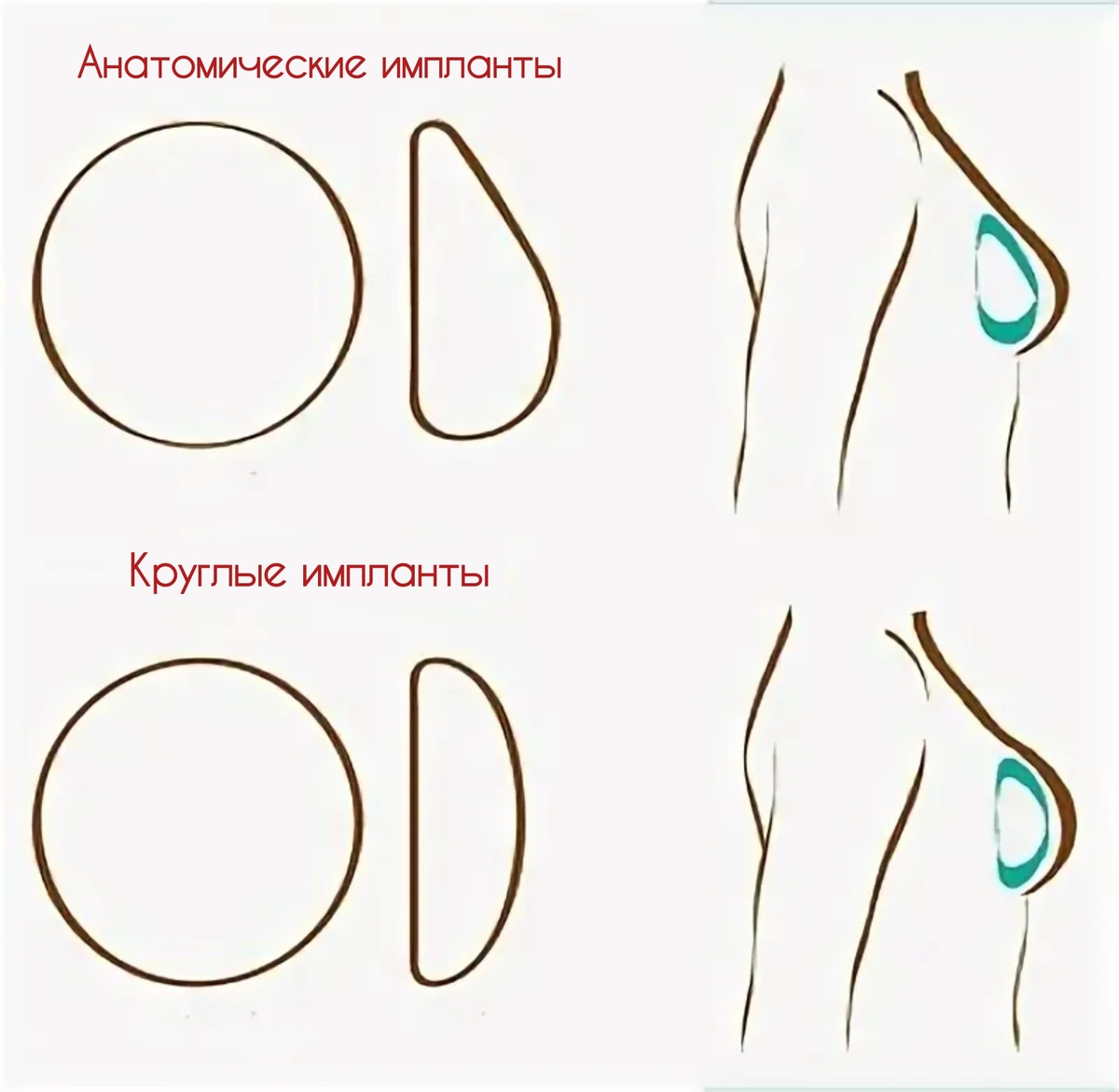 форма груди на круглых и анатомических имплантах