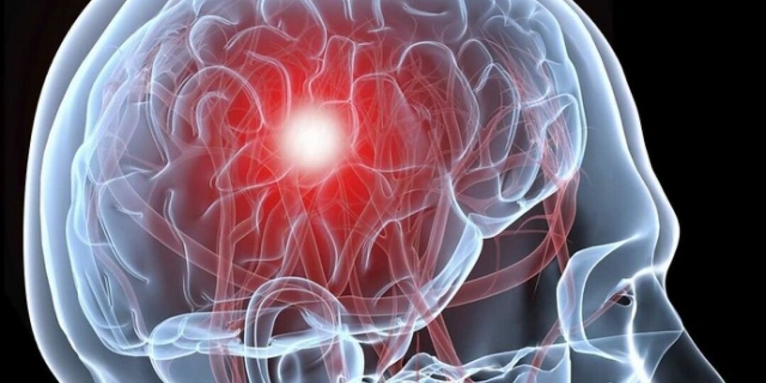 Инсульт: как распознать удар за 3 минуты и что делать, пока едет скорая