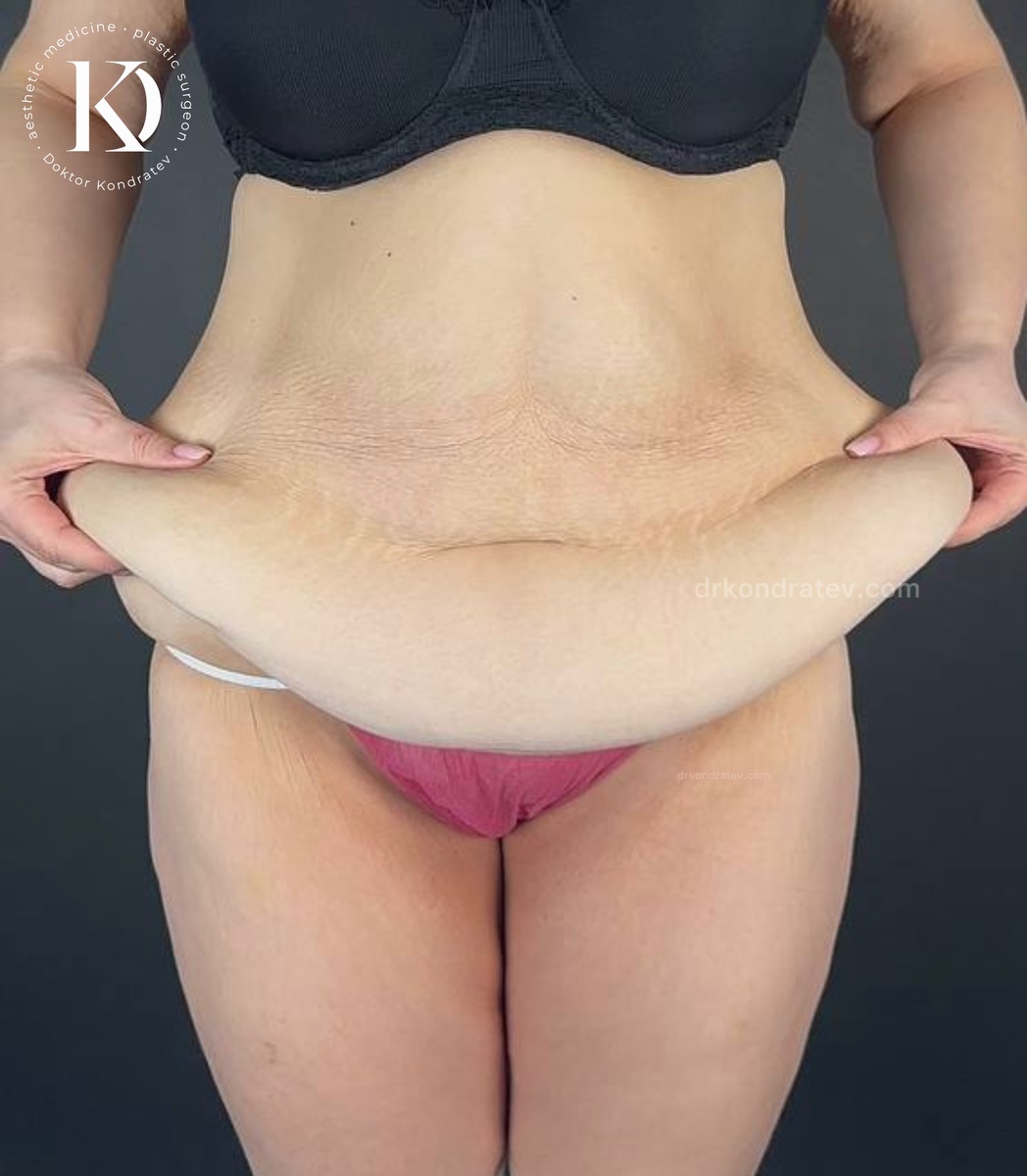 фото после массивного похудения