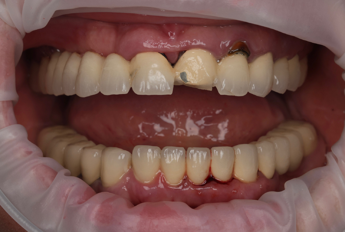 Ортопедический тотал из металлокерамики