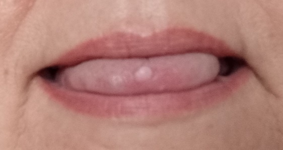 к чему соскочил типун на языке