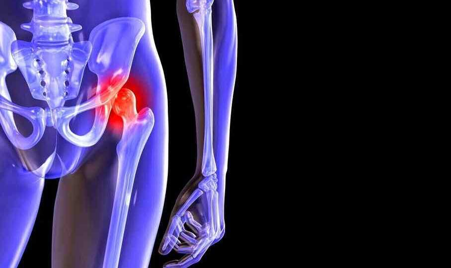Как победить коксартроз тазобедренного сустава: путь к подвижности без боли