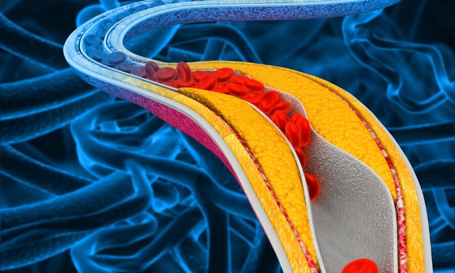 Атеросклероз что это такое, причины, симптомы и как его лечить