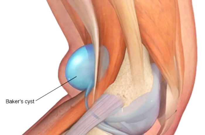 Рис. 01. Киста Бейкера, рисунок. Изображение из свободного доступа.
