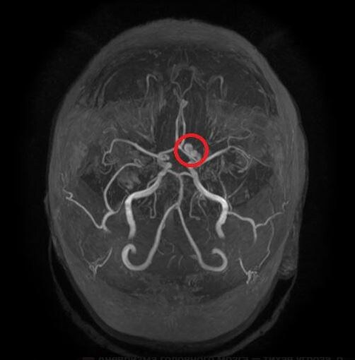 Аневризма головного мозга на МРТ