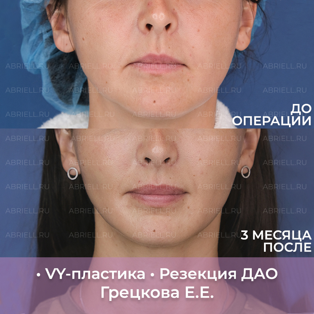 Пластическая операция: хирургическое увеличение губ без филлера и навсегда. Пластический хирург Грецкова Евгения Евгеньевна. Клиника Абриелль в Санкт-Петербурге 